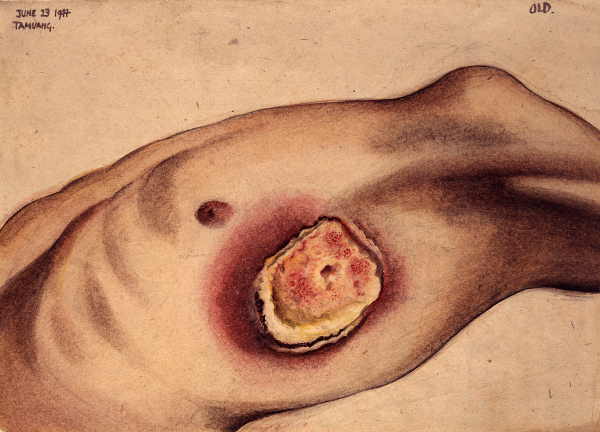 Watercolour of a large tropical ulcer on a male patient positioned on the upper left torso, beneath the armpit.